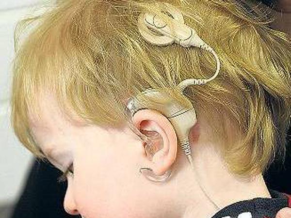 Kleiner Helfer. Das Cochlea- Implantat hilft beim Hören, ist aber umstritten.