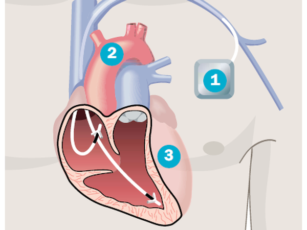 Der Herzschrittmacher (1) wird meist knapp unter dem Schlüsselbein unter die Haut gesetzt. Über eine Vene (2) gelangen die Elektrodenkabel zum Herzen (3), werden dort im Muskel verankert.