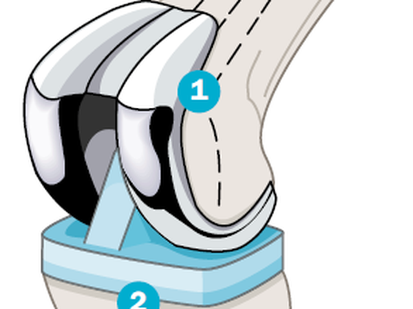 Eine Knieprothese ersetzt ein verschlissenes Gelenk und besteht meist aus drei Teilen: der Femurkomponente (1), also einer anatomisch geformten Gelenkfläche, einem Kunststoff-Inlay (2),das den Knorpel ersetzt, und der Tibiakomponente (3), die das Inlay im Knochen verankert.