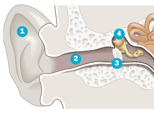 Schallwellen werden über die Ohrmuschel (1) und den äußeren Gehörgang (2) bis zum Trommelfell (3) geleitet. Dessen Schwingungen bewegen die Gehörknöchelchen (4), wodurch Vibrationen die Hörschnecke und den Hörnerven (5) im Innenohr erreichen.