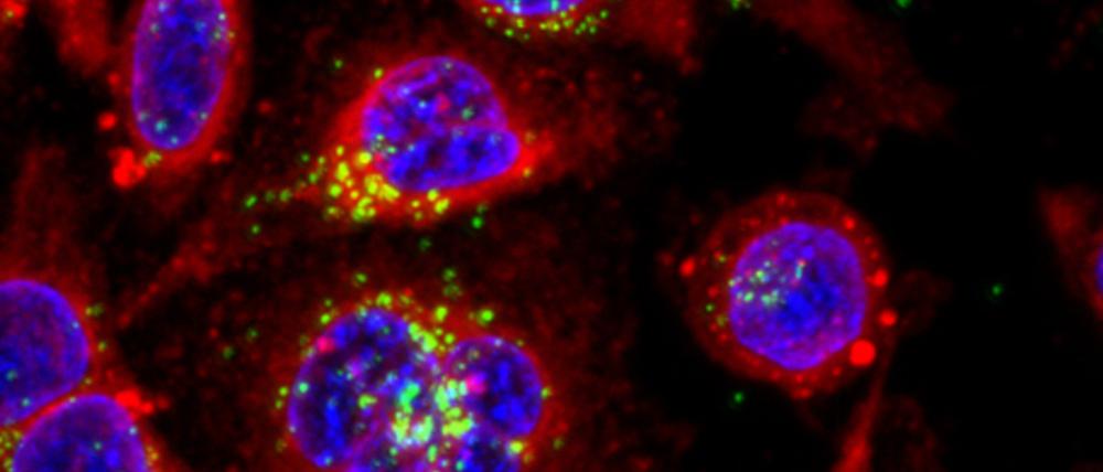 Grün ist hier leider nicht die Hoffnung, sondern das Mikro- und Nanoplastik in den Krebszellen.