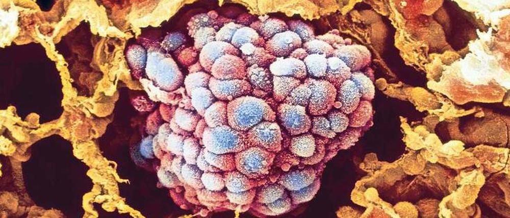 Die rasterelektronenmikroskopische Aufnahme zeigt blau eingefärbte Tumorzellen, die von Lungenbläschen (Alveolen) umgeben sind. 