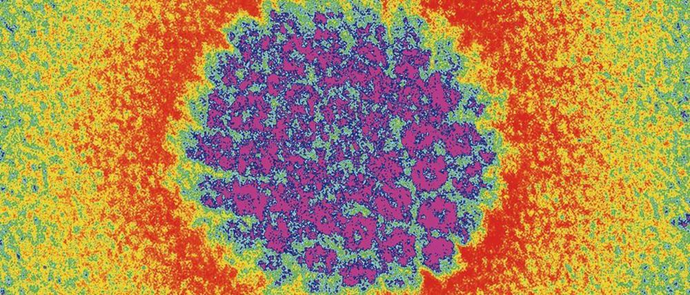 Das Epstein-Barr-Virus gehört zu den Herpes-Viren. Deren Erbgut (lila) besteht aus DNA, die von einer Kapsel umgeben ist. 