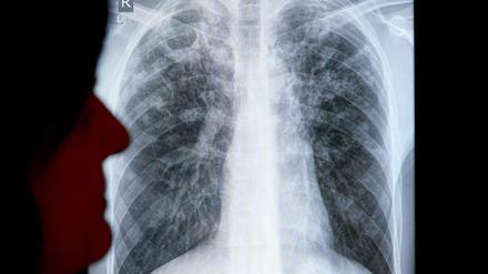 Geschädigte Lunge. Tuberkulose befällt häufig die Lunge. Röntgenaufnahmen helfen bei der Diagnose.