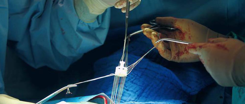 Beim minimalinvasiven Eingriff wird die neue Herzklappe entweder nahtfrei eingesetzt oder – wie im Bild – mit der Gefäßwand vernäht.