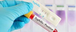 Jährlich infizieren sich in Deutschland etwa 8000 Menschen mit Syphilis - dabei hatte man geglaubt, die Krankheit sei ausgerottet.