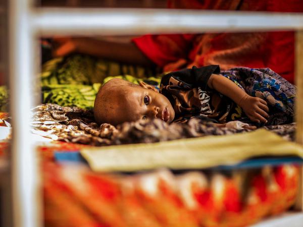 Ein schwer unterernährtes Kind wird in einem Stabilisierungszentrum in Äthiopien behandelt.