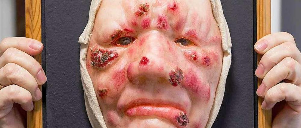 Eine Gesichtsmaske aus Wachs zur Veranschaulichung der Krankheitssymptome im Lepramuseum in Münster (Nordrhein-Westfalen).