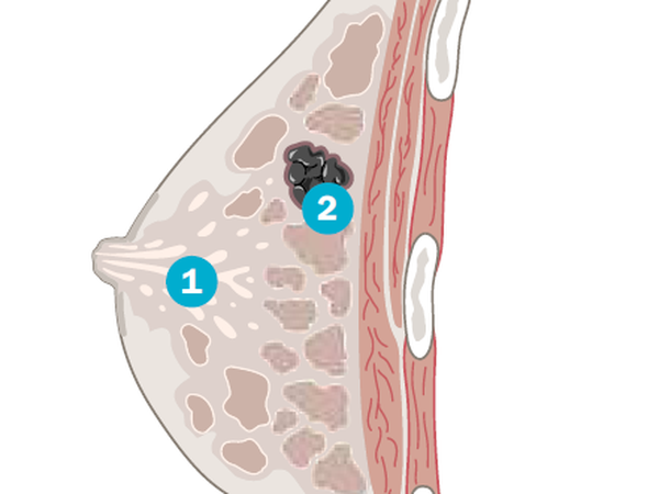 Die weibliche Brust besteht im Wesentlichen aus Binde- und Fettgewebe. Während der Stillzeit produzieren die Milchdrüsen der Brustdrüse die Muttermilch, die über die Milchgänge (1) zur Brustwarze gelangt. Bei Brustkrebs entstehen in und zwischen diesen Gängen bösartige Tumore (2), Mammakarzinome genannt.