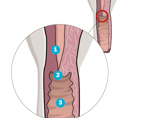 Der Gebärmutterhals (1) ist der untere Teil der Gebärmutter. Er mündet in den Muttermund (2), der die Gebärmutter nach unten hin zur Scheide (3) abschließt.