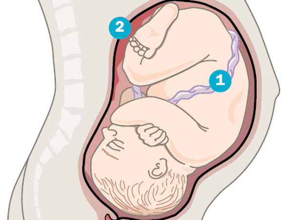 Nabelschnur (1) verbindet den Fötus mit der mütterlichen Plazenta (2). Etwa nach dem 30. Tag der Embryonal-entwicklung verbleiben imGewebeschlauch drei Gefäße:zwei Nabelarterien, die kohlendioxidreiches und nährstoffarmes Blut vom Kind zum Mutterkuchen leiten, und eine Nabelvene, die Blut von der Plazenta zum Kind führt.