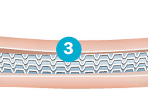 Ein Katheter (1) ist ein Kunststoffschlauch, spaghettidünn und bis zu 1,50 Meter lang. Er wird über die Hauptschlagader (Aorta) in die Herzkranzgefäße (2) - auch Koronararterien genannt - vorgeschoben. Über diesen Zugang kann der Arzt ein Kontrastmittel spritzen, durch das die Gefäße auf einem Röntgenbild sichtbar werden - und auch die Engstellen (3) in ihnen. Um den Katheter herum befindet sich ein Ballon, über dem ein geschlossener Stent (weißes Gitter) liegt.
