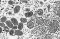 Elektronenmikroskopische Aufnahmen zeigt das Affenpockenvirus. Foto: Andrea Männel/dpa