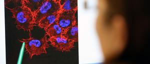 In einem Labor schaut eine Doktorandin auf ein Monitorbild von Melanom-Zellen (schwarzer Hautkrebs). 