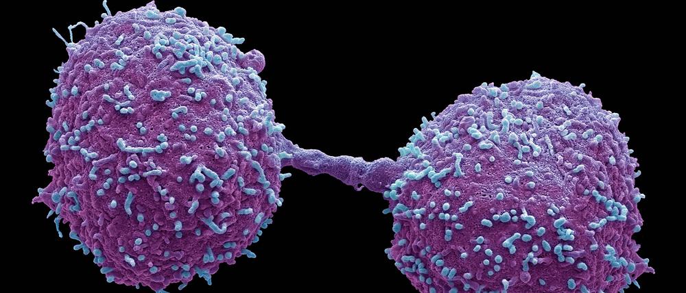 Am Anfang sind es nur wenige. Doch Krebszellen teilen sich extrem schnell. Stoppen lässt sich das umso besser, je früher der Tumor erkannt wird.