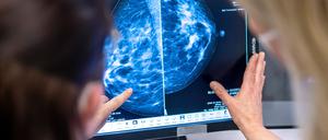 Medizinisches Personal untersucht mit einer Mammographie die Brust einer Frau auf Brustkrebs.