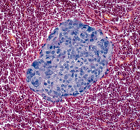Krebsnest. Die mikroskopische Aufnahme zeigt gestreute Brustkrebszellen (blau gefärbt) in einem Lymphknoten (rot eingefärbt). Foto: imago/Science Photo Library