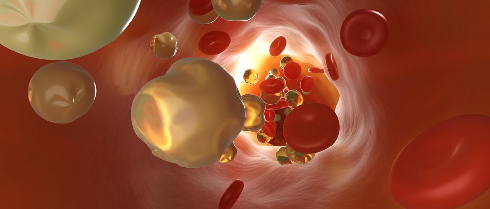 Manche Menschen haben erblich bedingt mehr krankmachende Cholesterin-Partikel im Blut.