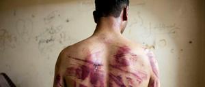 Spuren der Folter: Ein Syrer, der den Sicherheitskräften des Regimes entkommen konnte, zeigt seine Wunden.