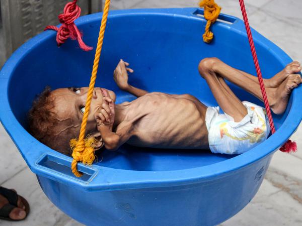 Millionen Kinder im Jemen sind lebensgefährlich unterernährt.