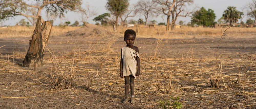 Ein Junge namens Giel trägt im vom Hunger bedrohten Südsudan ein weißes Plastikband am Knöchel. Es zeigt an, dass er an einer ambulanten Therapie teilgenommen hat. 