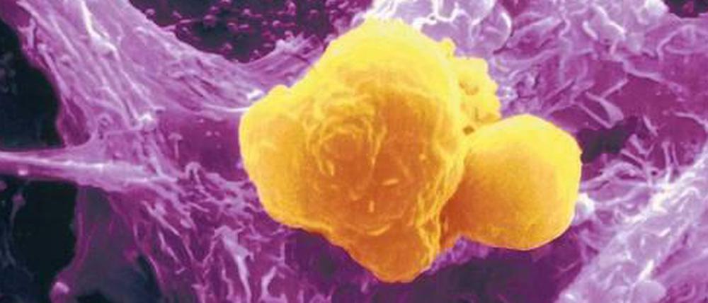Heilsame Attacke. Eine Fresszelle des Immunsystems fängt gelb eingefärbte Krebszellen ein. Solche Prozesse sollen durch Krebsimpfungen stimuliert werden.