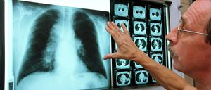 Entzündliche Verdichtungen des Gewebes sind gerade bei bakteriellen Pneumonien auf dem Röntgenbild oft gut sichtbar.