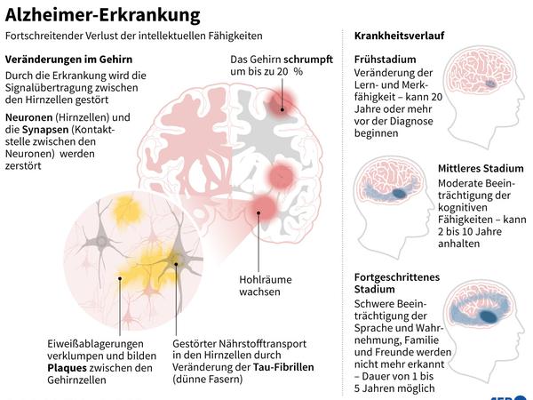 Krankheitsverlauf und Veränderungen bei Alzheimer im Gehirn.
