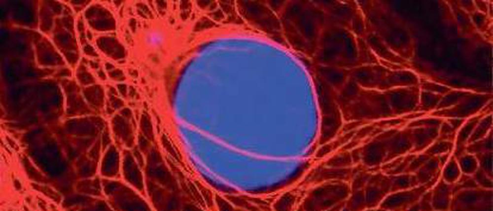 Ob ein Brustkrebs mit Chemotherapie behandelt werden kann, hängt vom genetischen Make-up im Zellkern (blau) der Krebszellen einer Patientin ab. Tests können das nachweisen und Patientinnen die Chemotherapie ersparen. Doch in Deutschland sperren sich die Behörden noch immer gegen eine Erstattung der Kosten.