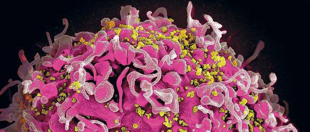 Infiziert. Elektronenmikroskopische Aufnahme von HIV-Viren, die eine menschliche Zelle kapern. 