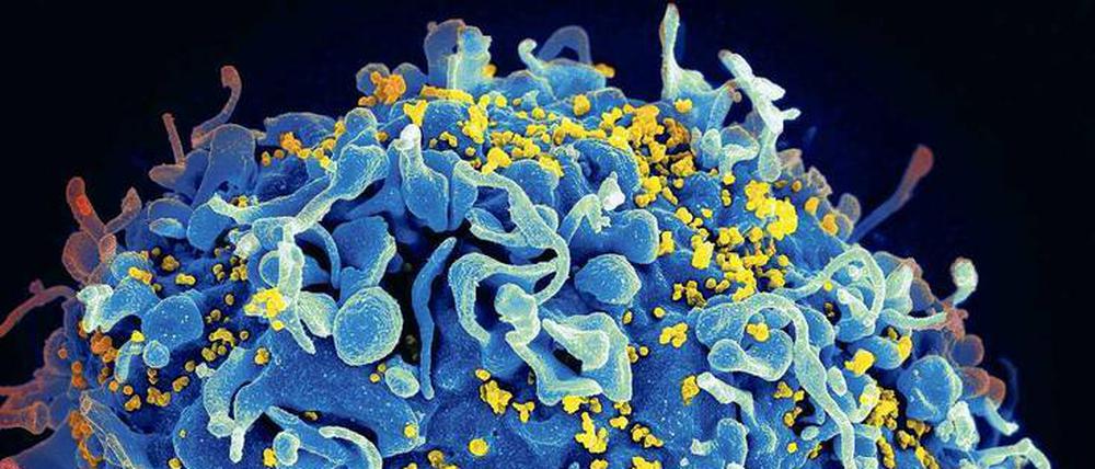 Gelbe Gefahr. Die rasterelektronenmikroskopische Aufnahme zeigt gelb eingefärbte Immunschwächeviren auf der Oberfläche einer blau eingefärbten T-Zelle. Diese Zellen gehören zum Immunsystem des Organismus und sind das Hauptziel des Aids-Erregers. 