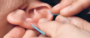 Nadel im Ohr. Akupunktur gehört zu den verbreiteten Alternativ-Verfahren. 