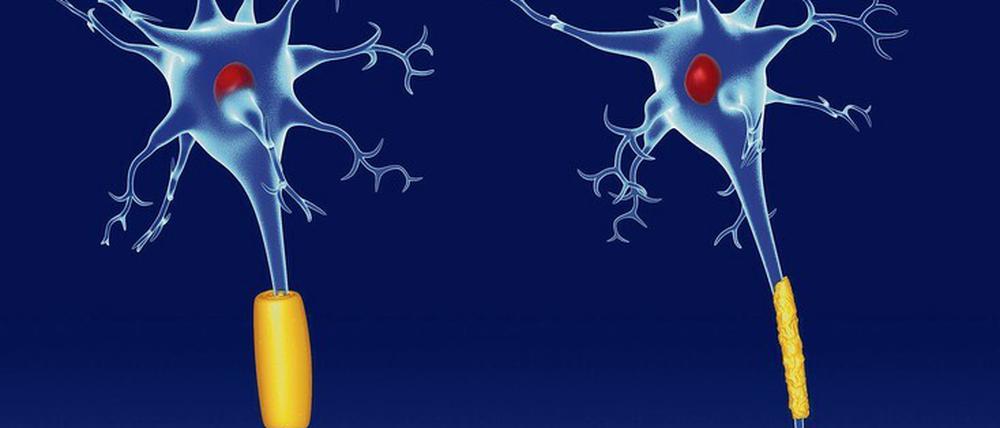 Gesunde Nervenzellfortsätze (links) sind von speziellen Hüllen, sogenannten Myelinscheiden, umgeben. Sie beschleunigen die Reizübertragung. Bei Multipler Sklerose zerstört das Immunsystem diese Hüllen.(rechts).