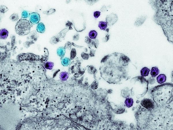 HIV (blau coloriert) und Leukämieviren (HTLV, türkis) beim Befall einer Zelle (grau, unten). 