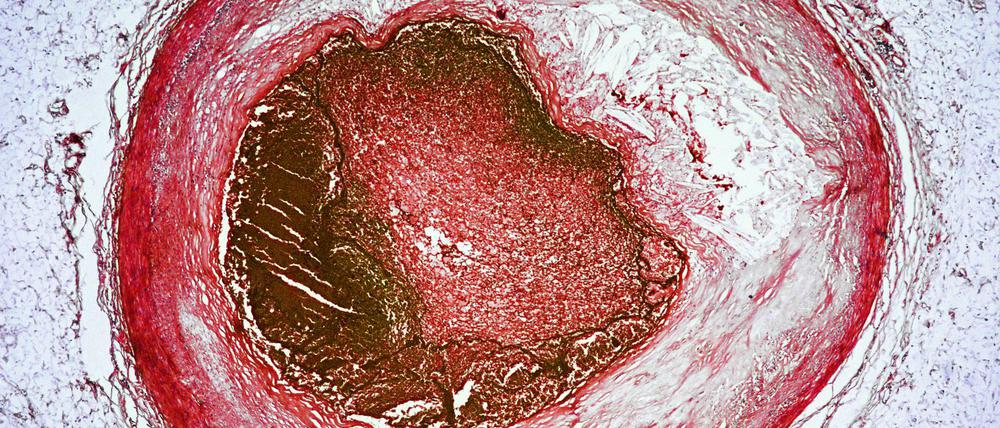 Eingeengt. Bei einer Thrombose gerinnt Blut an der Gefäßwand, wie hier in einer Herzkranzarterie.