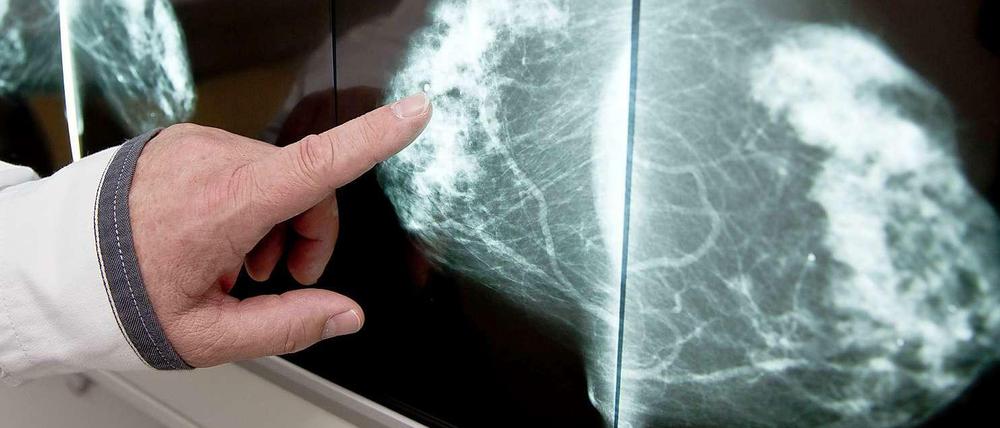 Blick von oben. Die klassische Mammografie bietet nur eine Draufsicht auf die Brust. In dem 2-D-Bild können sich verschiedene Strukturen überlagern und eine Wucherung vortäuschen.