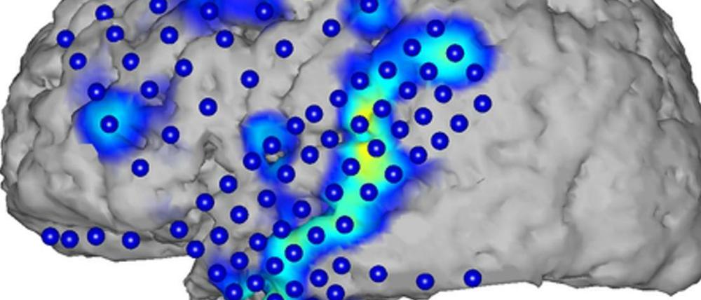 Beim Sprechen zuschauen. Mittels Elektrokortikographie wird Gehirnaktivität aufgezeichnet (blaue Kreise). Aus den Aktivitätsmustern (blau/gelb) lassen sich die gesprochenen Wörter erkennen - zumindest näherungsweise. 