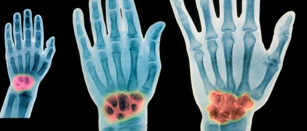 Die Röntgenuntersuchung der Handwurzelknochen (links von einem Zweijährigen, mittig von einem Siebenjährigen und rechts von einem Erwachsenen) soll sich das Alter junger Menschen auf etwa ein Jahr genau bestimmen lassen. 